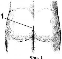 Способ хирургического лечения спондилолистеза (патент 2356509)