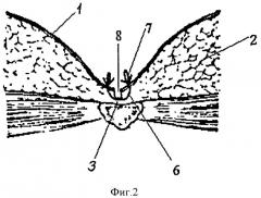 Способ хирургического лечения гнойного воспаления эпителиального копчикового хода (патент 2400156)