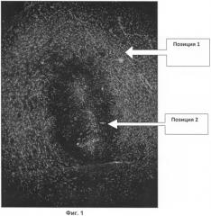 Способ визуализации астроглиального вала в диагностике низкодифференцированных глиом (патент 2437159)