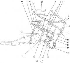 Способ оперативного лечения переломов пяточной кости спицестержневым аппаратом (патент 2321369)