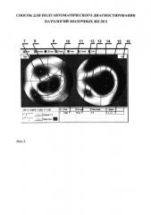 Способ для полуавтоматического диагностирования патологий молочных желёз (патент 2622362)