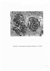 Способ диагностики низко дифференцированного нейроэндокринного рака желудка (патент 2613300)