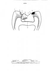 Способ протезирования дефектов твердых тканей жевательных зубов вкладками (патент 1607796)