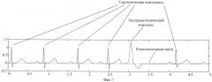 Способ выявления аритмии электрокардиосигнала в реальном времени и устройство для его осуществления (патент 2438568)