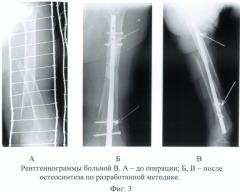 Способ лечения переломов трубчатых костей при выраженном остеопорозе (патент 2494694)