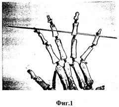 Способ лечения повреждения сухожилия разгибателя пальца кисти на уровне дистальных межфаланговых суставов (патент 2323693)