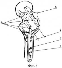 Вильчатая пластинка для остеосинтеза эпиметафизарных переломов (варианты) (патент 2266719)