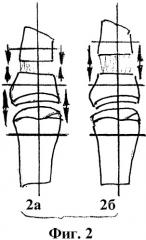 Способ удлинения коротких культей пальцев кисти (патент 2428940)