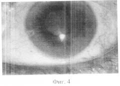 Способ лечения воспалительных состояний переднего отрезка глаза (патент 2513597)