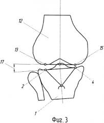 Способ дифференцированной оценки деформаций коленного сустава и выбора вида хирургического лечения при гонартрозе (патент 2498772)