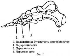 Способ и устройство для исправления дефектов стопы (патент 2301039)