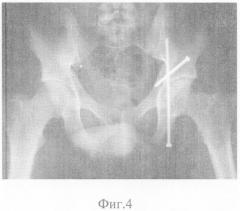 Способ закрытого остеосинтеза переломов вертлужной впадины (патент 2327427)