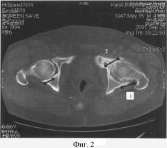 Способ диагностики локальных участков компрессии тазобедренного сустава у больных коксартрозом методом компьютерной томографии (патент 2377954)