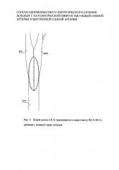 Способ одномоментного хирургического лечения больных с патологической извитостью общей сонной артерии и внутренней сонной артерии (патент 2618209)