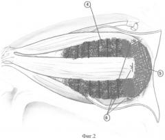 Способ формирования опорно-двигательной культи для глазного протеза (патент 2337652)