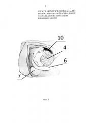 Способ хирургической санации инфралабиринтной-апикальной холестеатомы пирамиды височной кости (патент 2635483)