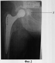 Способ цементной фиксации вертлужного компонента при тотальном эндопротезировании тазобедренного сустава у больных с остеопорозом (патент 2312629)
