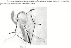 Способ хирургического лечения распространенного рака кожи околоушной области с метастазами в лимфатические узлы шеи (патент 2445005)