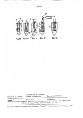 Зубной имплантат и способ его установки (патент 1547816)