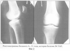 Способ определения глубины и распространенности остеонекроза у пациентов с начальными стадиями рассекающего остеохондрита коленного сустава для проведения артроскопических операций (патент 2284149)