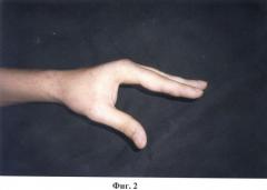 Способ реабилитации разгибательных контрактур пальцев кисти (патент 2471467)