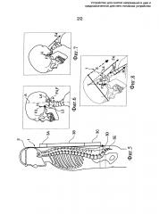 Устройство для снятия напряжения в шее (патент 2607367)
