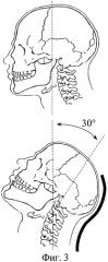 Способ лечения флегмоны дна полости рта (патент 2284765)