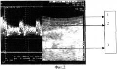 Способ диагностики цереброваскулярных резервов и прогнозирования сосудистой патологии зрительного нерва при дисциркуляторной энцефалопатии у геронтологических больных (патент 2316257)