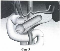 Способ резекции поджелудочной железы при хроническом панкреатите (патент 2465842)