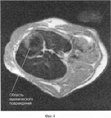 Способ магнитно-резонансной томографической диагностики ишемических нарушений коронарного кровообращения (патент 2330609)