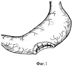 Способ ушивания прободной язвы желудка больших размеров при диффузном перитоните (патент 2296514)