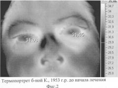 Способ диагностики ишемии зрительного нерва (патент 2299672)