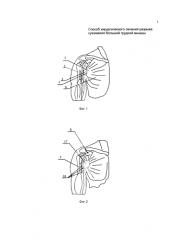 Способ хирургического лечения застарелого разрыва сухожилия большой грудной мышцы (патент 2585412)