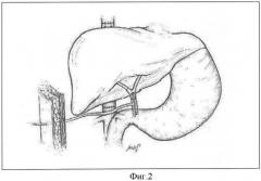 Способ восстановления оттока желчи при ортотопической трансплантации печени (патент 2347536)