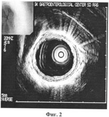Способ диагностики пищевода баррета (патент 2343839)