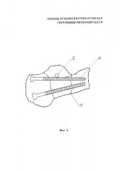 Способ лечения внутрисуставных переломов пяточной кости (патент 2630870)