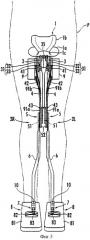 Устройство, облегчающее ходьбу (патент 2389468)