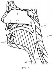 Магнитные имплантаты для лечения обструктивного апноэ сна (патент 2508919)