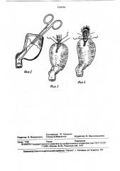 Способ проксимальной резекции желудка при язвах (патент 1734704)