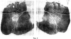 Способ формирования представления (шаблона) папиллярных узоров ладони человека (патент 2554520)