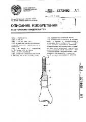 Эндопротез трубчатой кости (патент 1373402)