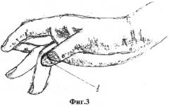 Способ формирования ногтевой фаланги i пальца кисти (патент 2548517)