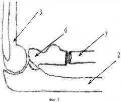 Способ открытого вправления головки лучевой кости при ее вывихе у детей (патент 2421172)