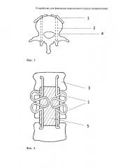 Устройство для фиксации поясничного отдела позвоночника (патент 2596094)