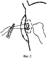 Способ иссечения больших и гигантских язв малой кривизны желудка у больных с высокой степенью операционного риска и устройство для его осуществления (патент 2415650)