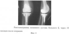 Способ лечения гнойного артрита, развившегося после тотального эндопротезирования коленного сустава (патент 2317022)