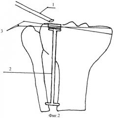 Способ оперативного лечения компрессионных переломов мыщелков большеберцовой кости (патент 2375983)