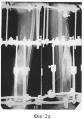 Способ замещения дефекта кости с наличием центральнорасположенного остеомиелитического очага у детей (патент 2515685)
