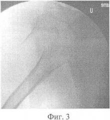 Способ хирургического лечения оскольчатых переломов проксимального отдела плечевой кости напряженными спицами (патент 2357692)