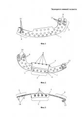 Эндопротез нижней челюсти (патент 2610533)
